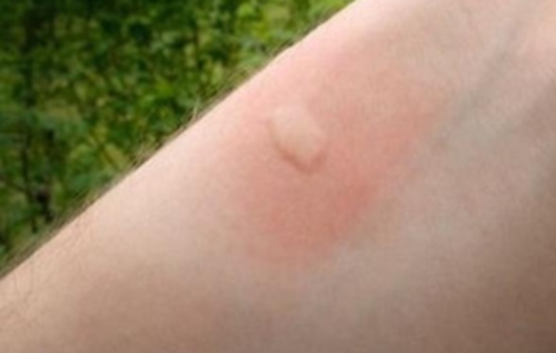 Un bouton dû à une piqûre d'un moustique tigre